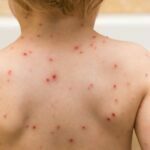 Jueves 17 de Marzo de 2022 | Matutina para Adolescentes | La vacuna contra la varicela