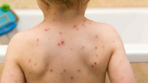 Lee más sobre el artículo Jueves 17 de Marzo de 2022 | Matutina para Adolescentes | La vacuna contra la varicela